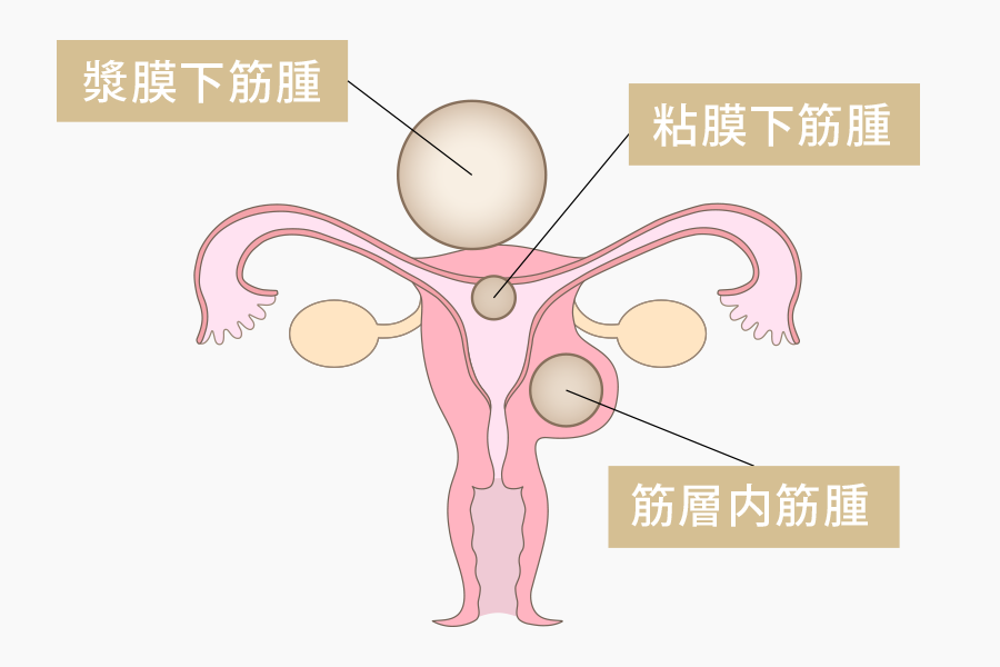 子宮筋腫の種類