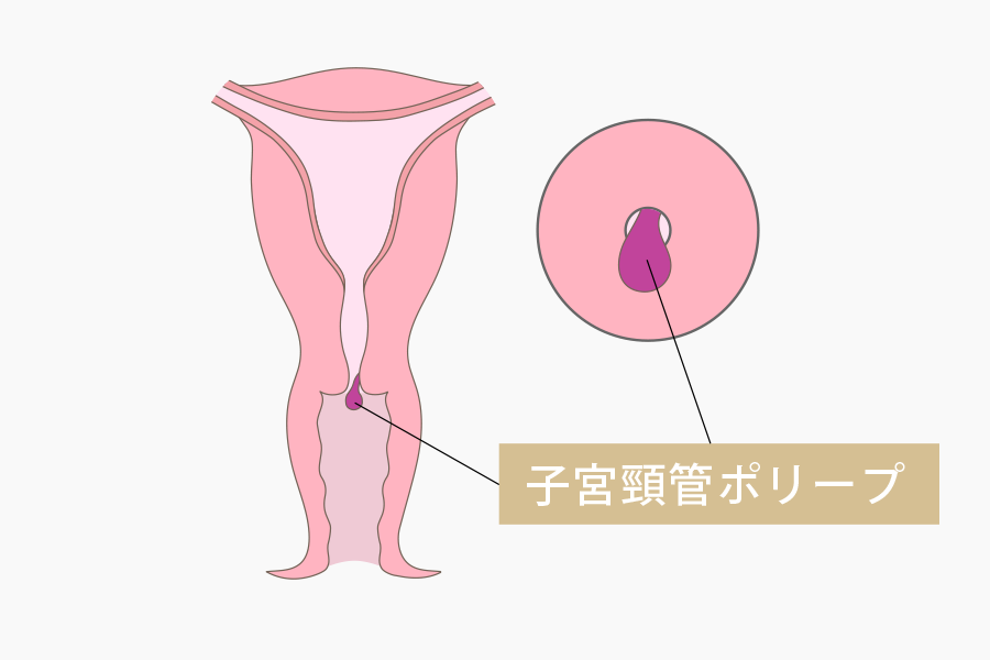 子宮頸管ポリープ