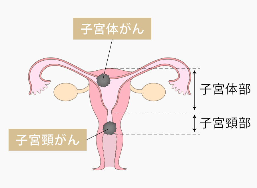 子宮がん